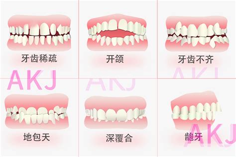 上排牙齒蓋住下排牙齒|深咬也是一種咬合問題！有7種可能原因與6種風險 